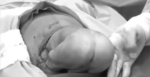Ils filment le bébé se faire extraire de l’utérus de sa mère par césarienne. Les images sont saisissantes.