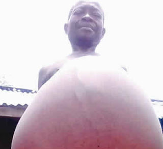 nigerian man whose belly won't stop growing imo state nigerian man whose belly won't stop growing imo state