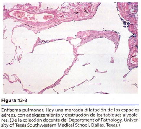 Agustina Ocampo - Patología B 2014: EPOC (Enfisema y Bronquitis crónica)