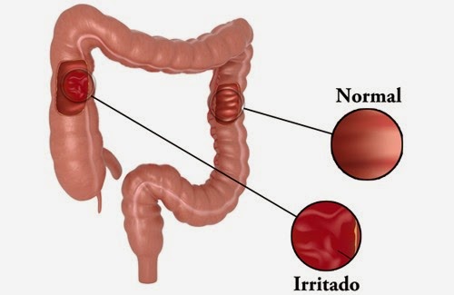Sindrom de colon iritabil