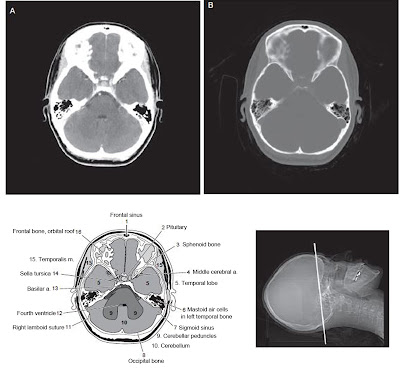 brain CT scan