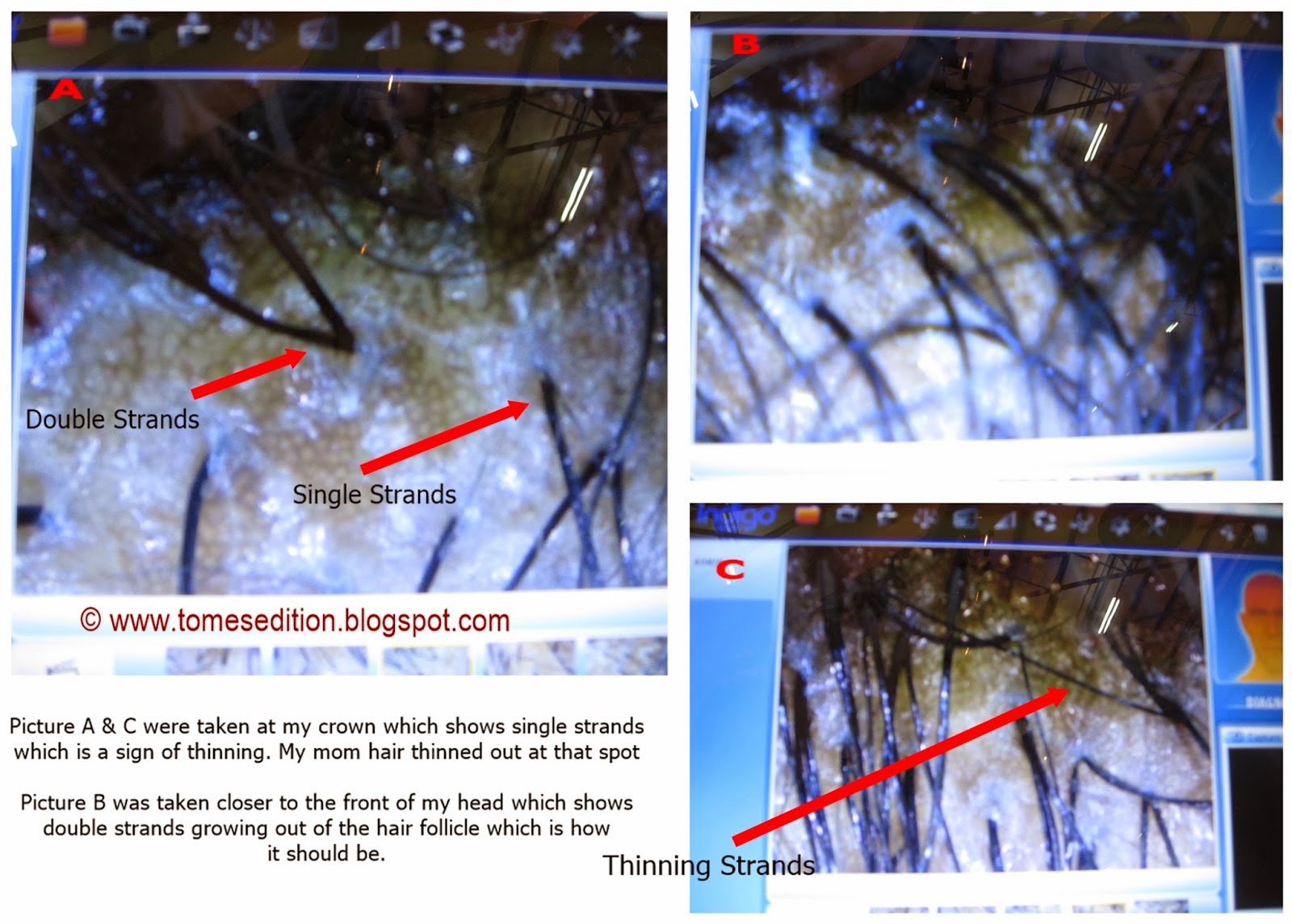 Tomes Edition I Got A Scalp Test From A Certified Trichologist…