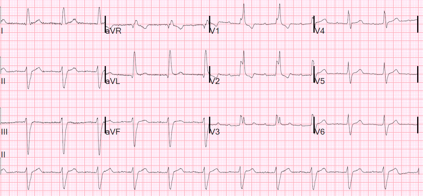 rbbb ecg