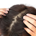 Does Dandruff perpetually Go Hand In Hand With Telogen Effluvium?