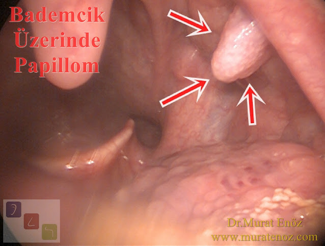 papilloma in the tongue,HPV treatment in the mouth,AHCC,squamous papilloma,HPV wart in the mouth,oral papilloma,HPV,