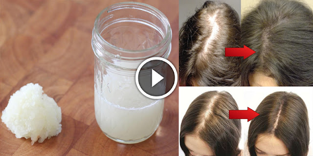 Hair Thinning Homemade Treatment For Hair Fall And Bald Spots And
