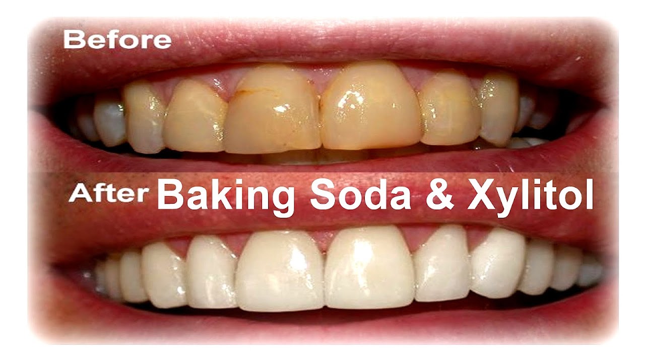 How To Clean Your Yellow Teeth Yellow Choices