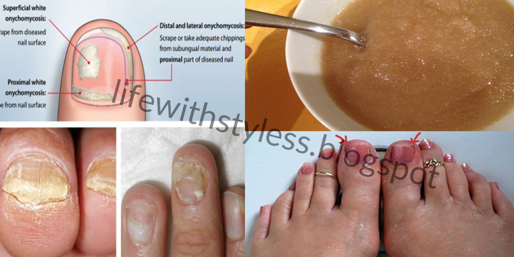 Natural home treatment for fungal nail infection Natural Home Treatment for Fungal Nail Infection | Life With Styles