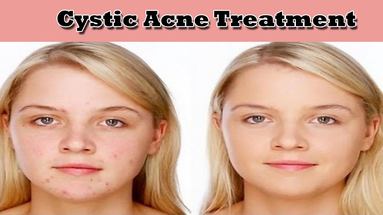 Cystic Acne Treatment Skin Beauty