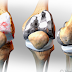 What a knee surgery is all about