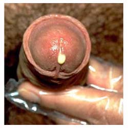 Obat Sakit Dan Keluar Nanah Di Penis Obat Sakit Dan Keluar Nanah Di Penis