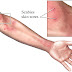 Obat Gatal Scabies Paling Ampuh Sembuh Permanen
