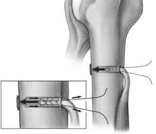 tenodesis biceps screw surgery loose arthritis causes positive shoulder culture rotator tears cuff pain grossly sent device five days his