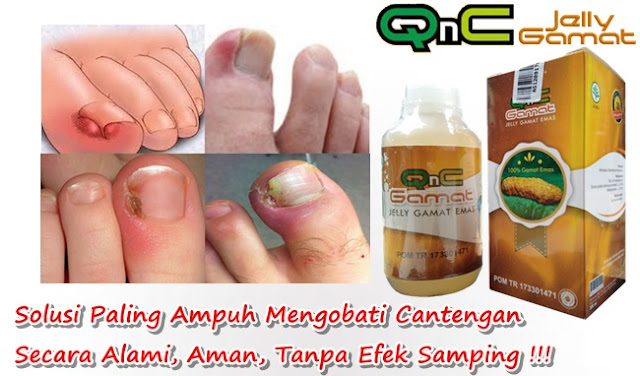 Cara Mengobati Cantengan Secara Alami Cara Mengobati Cantengan