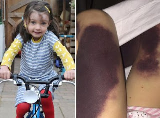 Menina de 4 anos quase tem pernas amputadas devido a catapora