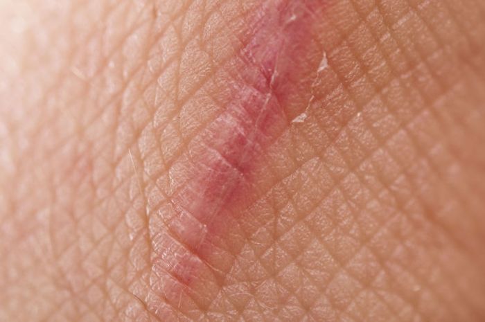 Cara Menghilangkan Keloid pada Kulit Bayi Cara Menghilangkan Keloid pada Kulit Bayi