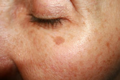 Cómo eliminar las manchas por la edad en la piel. Cómo eliminar las manchas por la edad en la piel.