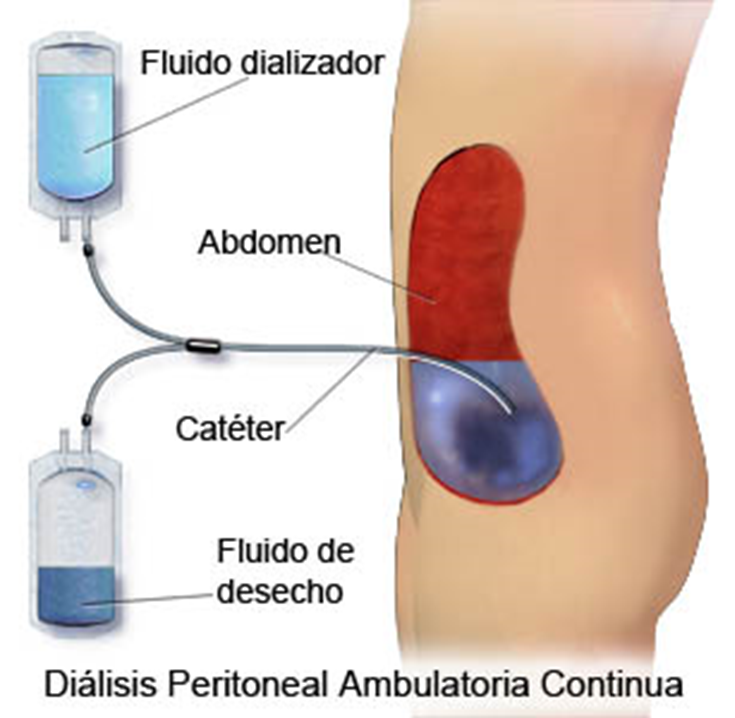 Insuficiencia Renal ¿Qué es el programa de Diálisis Peritoneal? Insuficiencia Renal ¿Qué es el programa de Diálisis Peritoneal?