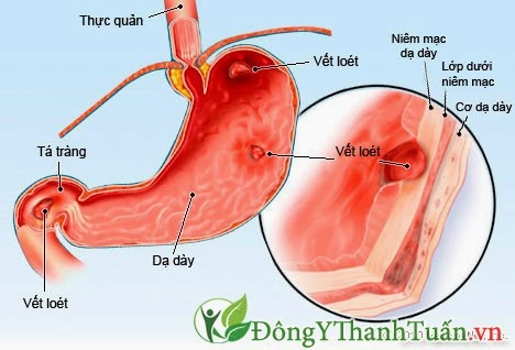 Nguyên nhân gây hôi miệng từ dạ dày