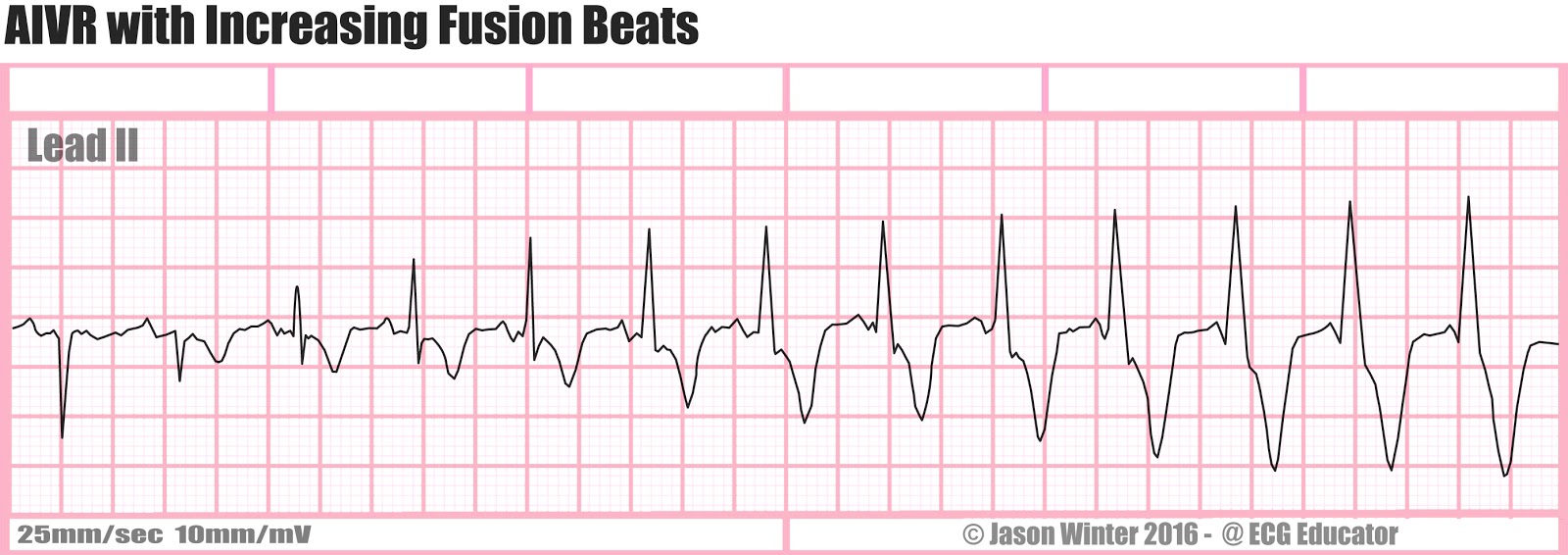 ECG Educator Blog Accelerated Idioventricular Rhythm (AIVR)