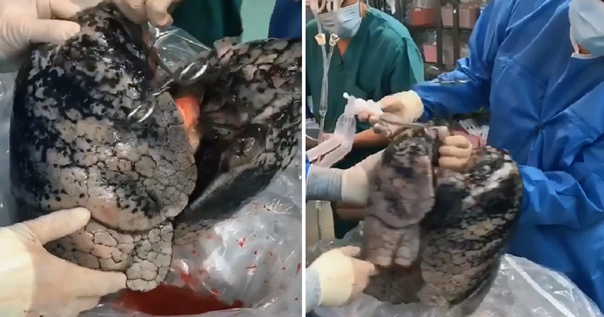 Shocking Footage Shows How The Human Lungs Look After 30 Years Of Smoking