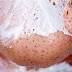Use this Simple and Effective Trick and Get Rid of Blackheads