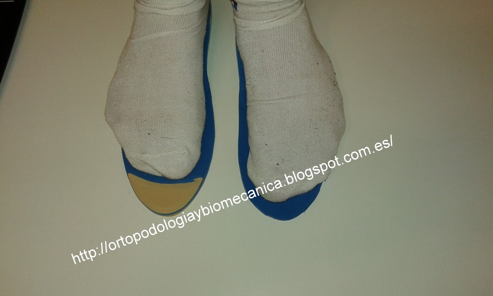 Ortopodologia y Biomecanica PLANTILLAS PARA UN PIE MAS CORTO QUE OTRO