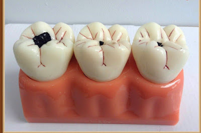 Điều trị tủy răng thực hiện như thế nào?