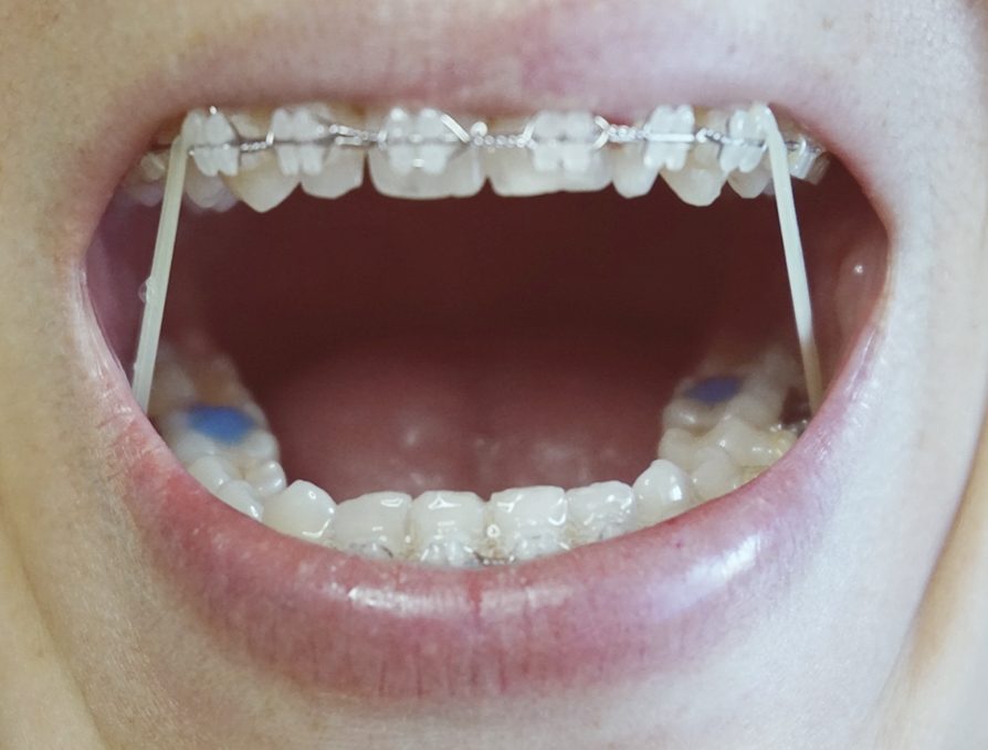 Gomas brackets ponen porque