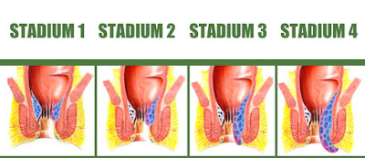 Tingkatan Atau Stadium Wasir