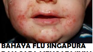 Apa ciri dan penanganan flu singapura pada anak