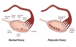 Rawat Cysts dan PCOS secara semulajadi tanpa pembedahan