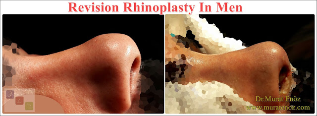 Revision rhinoplasty in İstanbul - Revision rhinoplasty in Turkey - Revision rhinoplasty istanbul - Revision rhinoplastyTurkey - Revision nose job in İstanbul - Revision nose job in Turkey - Revision Nose Job Surgery For Men in Istanbul - Revision Male Rhinoplasty in Istanbul - Men's Revision Rhinoplasty in Turkey - Revision Nose Reshaping For Men in Istanbul - Mens Revision Rhinoplasty in Istanbul - Revision Nose Job Rhinoplasty For Men in Istanbul - Best Revision Rhinoplasty For Men Istanbul - Revision Nose Aesthetic For Men in Istanbul - Male Revision Nose Operation in Istanbul - Male Revision Rhinoplasty Surgery in Istanbul - Male Revision Rhinoplasty Surgery in Turkey - Male Revision Nose Aesthetic Surgery in Istanbul - Revision Rhinoplasty In Mens Istanbul