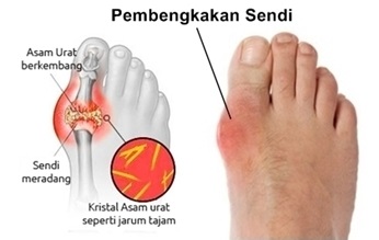 Obat Asam Urat Terbaik untuk Kesembuhan