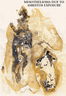 Malignant Mesothelioma Malignant Mesothelioma