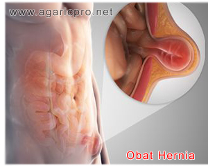 Obat Hernia Herbal Paling Terkemuka Dan Mengesankan Keampuhanya Obat Hernia Herbal Paling Terkemuka Dan Mengesankan Keampuhanya