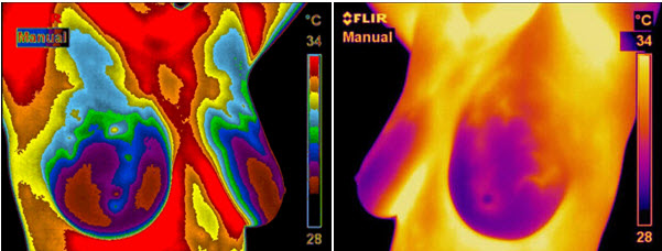 temperature variations of breast