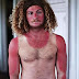 OW du soleil! The lobstered sunbathers left with sore and sun-damaged skin... and bruised egos to match (15 Pics)