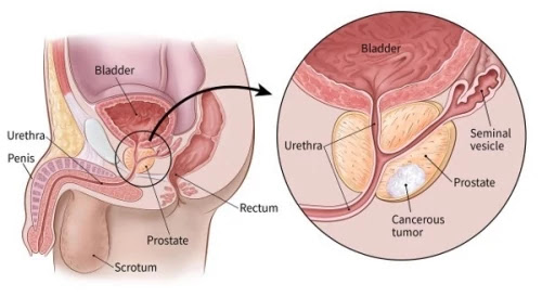 Prostate Gland पौरुष ग्रन्थि वृद्धि : कारण , लक्षण और चिकित्सा Prostate Gland पौरुष ग्रन्थि वृद्धि : कारण , लक्षण और चिकित्सा