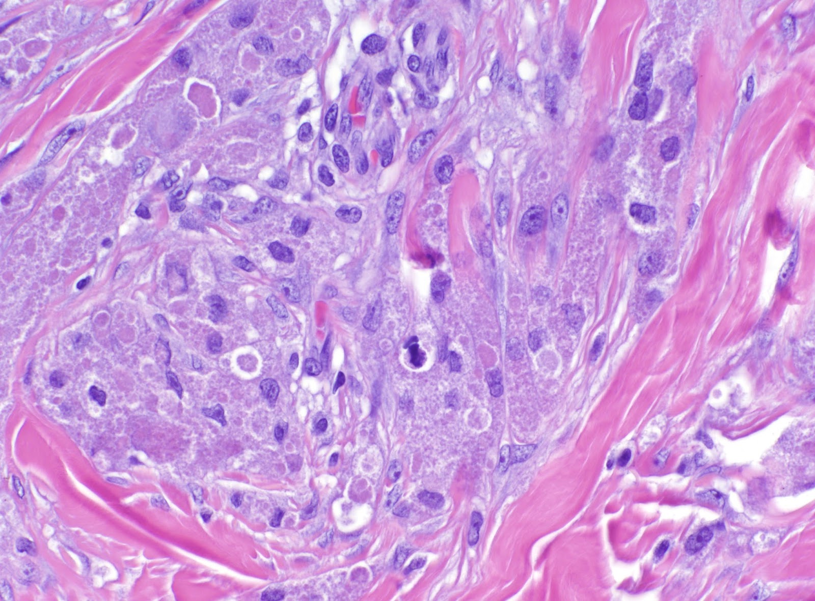 Pity, anus cell granular tumor Anus cell granular tumor consider