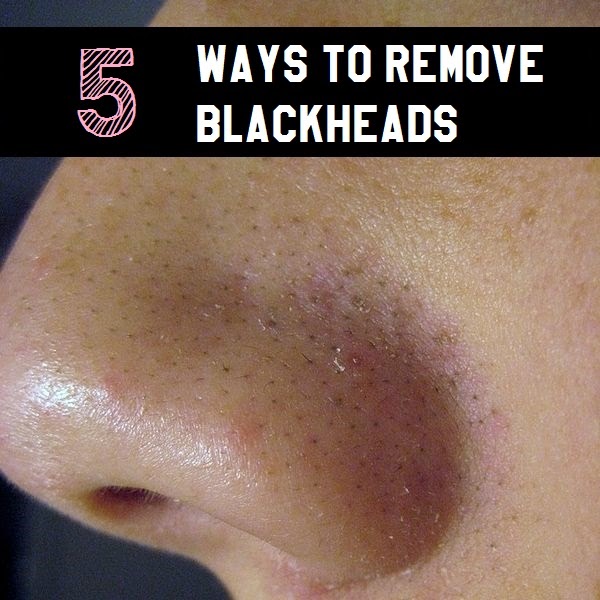 How to remove blackheads How To Beauty
