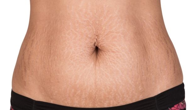 como eliminar las estrias naturalmente