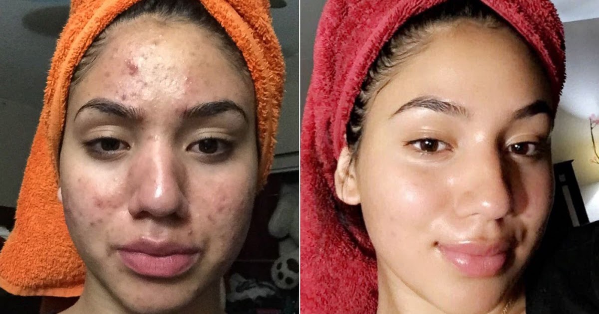 How to Cure and Prevent Teenage Acne ? - beauty4everything3