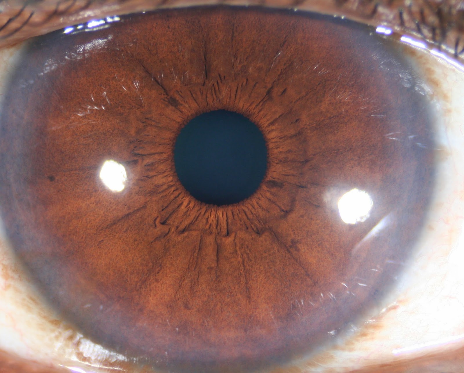 Modern & Multidimensional Iridology MI Analysis of the Iris Pigmentation & Combination Signs