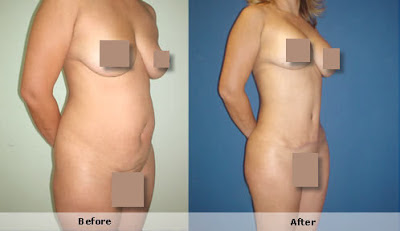 Antes e Depois Mamoplastia de Aumento Antes e Depois Mamoplastia de Aumento