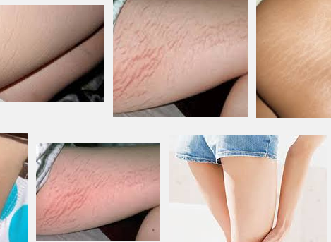Las de los como gluteos estrias rojas quitar