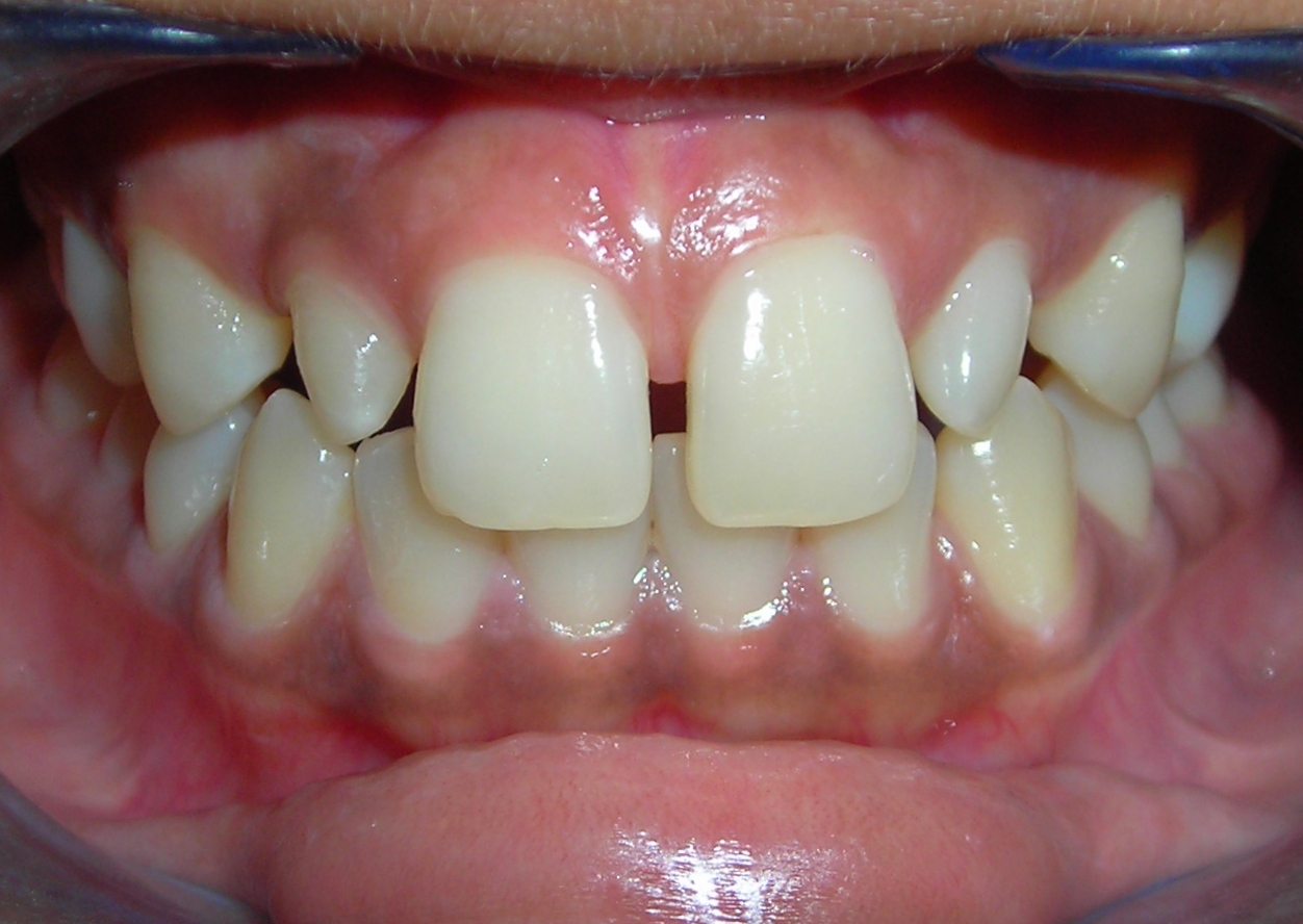 Restorative Dentistry & Endodontics Pegged for Crown