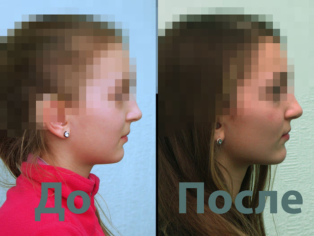 Профиль пациента до и после лечения. ортодонтическое лечение не ухудшает форму лица пациента. Это видно из фото до и после лечения.