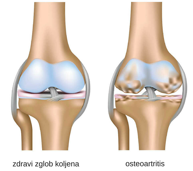 Osteoartritisa stopala kao neverovatno podmuklu bolest