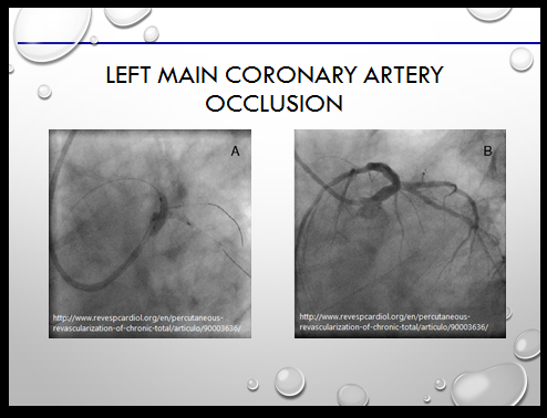 left artery blockage maker widow main coronary shows telemetry technician course improved flow blood almost complete